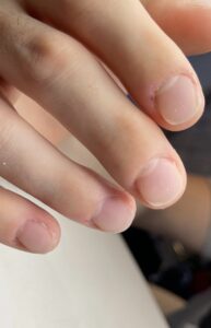 Nagelbeisser Behandlung Mann Zürich nachher